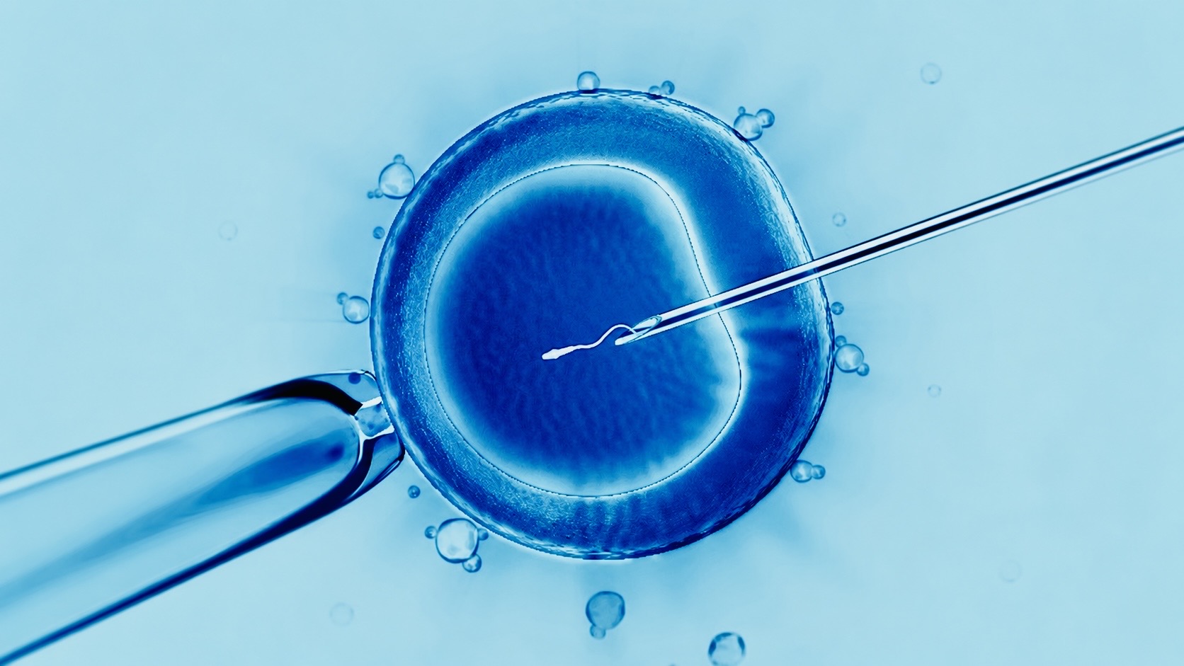 Microscopic view of a single sperm being injected into a human egg during an intracytoplasmic sperm injection procedure used in IVF.